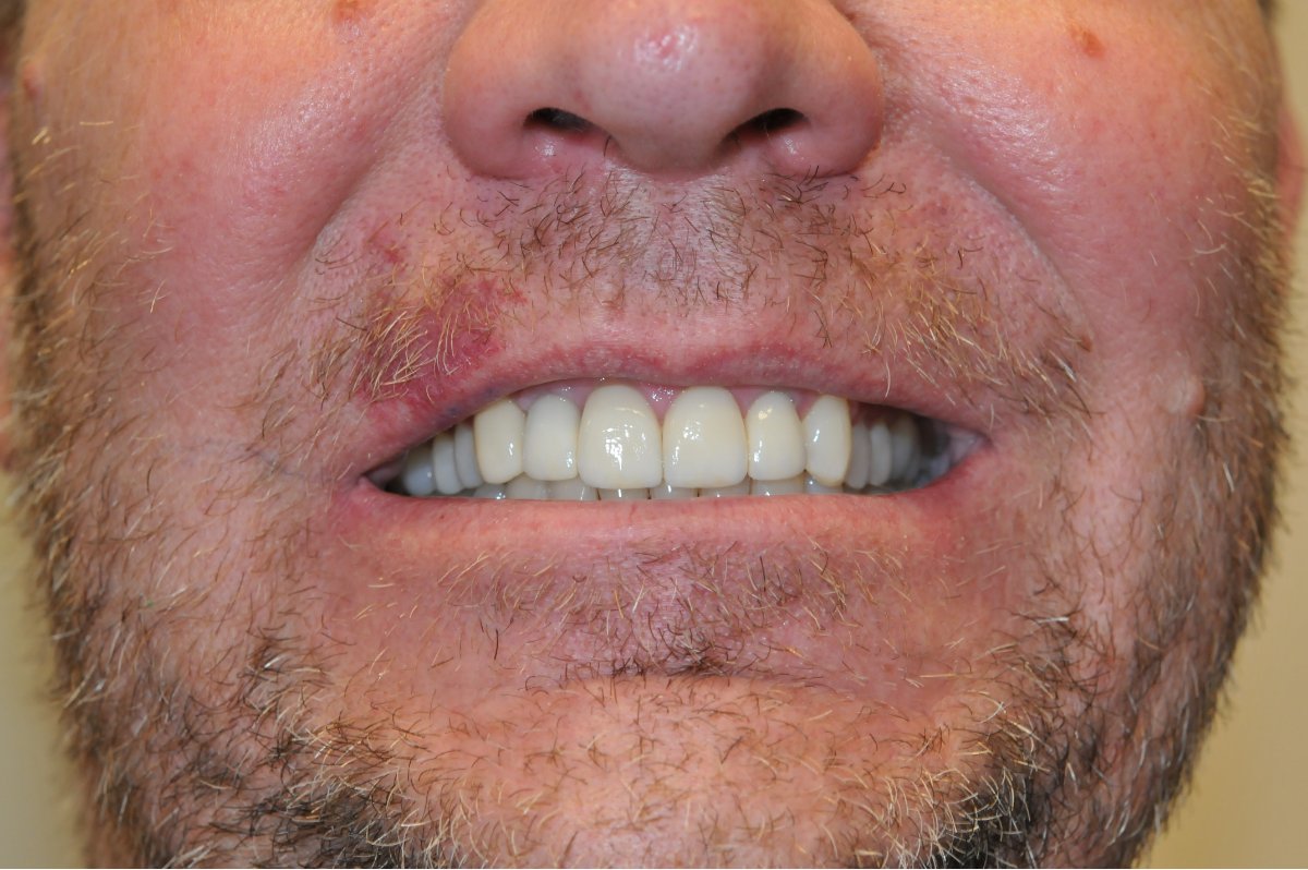 Before and after smiles at Alleman Family Dental Boulder, CO